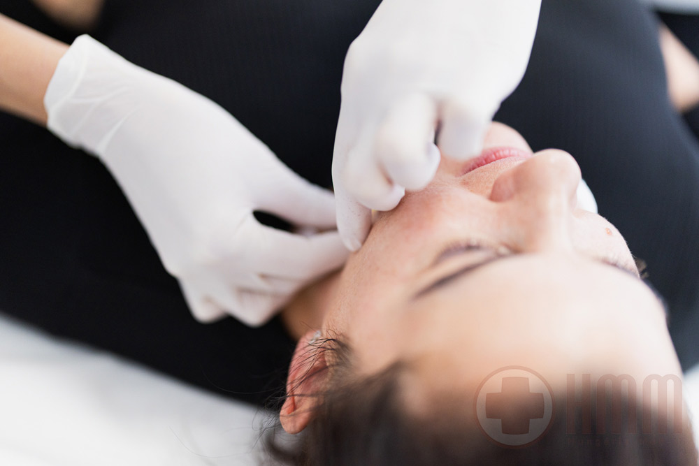 Bioszálas arcfiatalítás