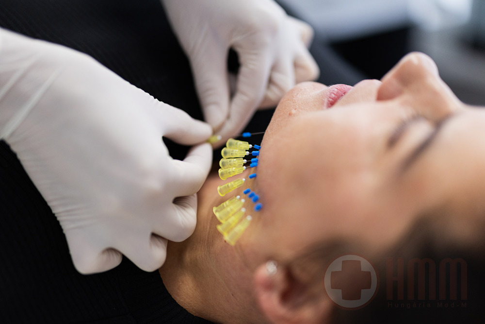 Bioszálas arcfiatalítás